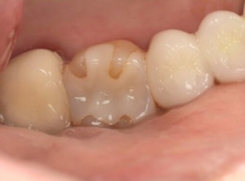 セラミックとの接着部分に段差がある歯の症例１
