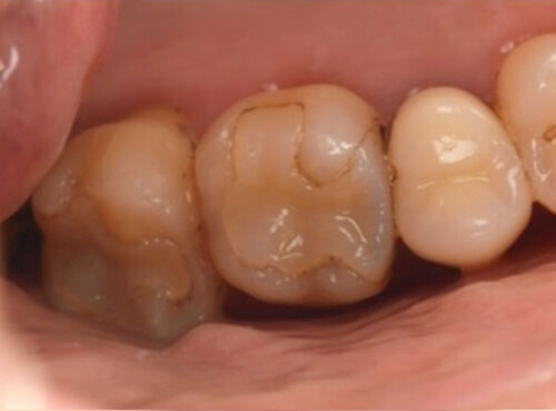 セラミックとの接着部分に段差がある歯の症例２