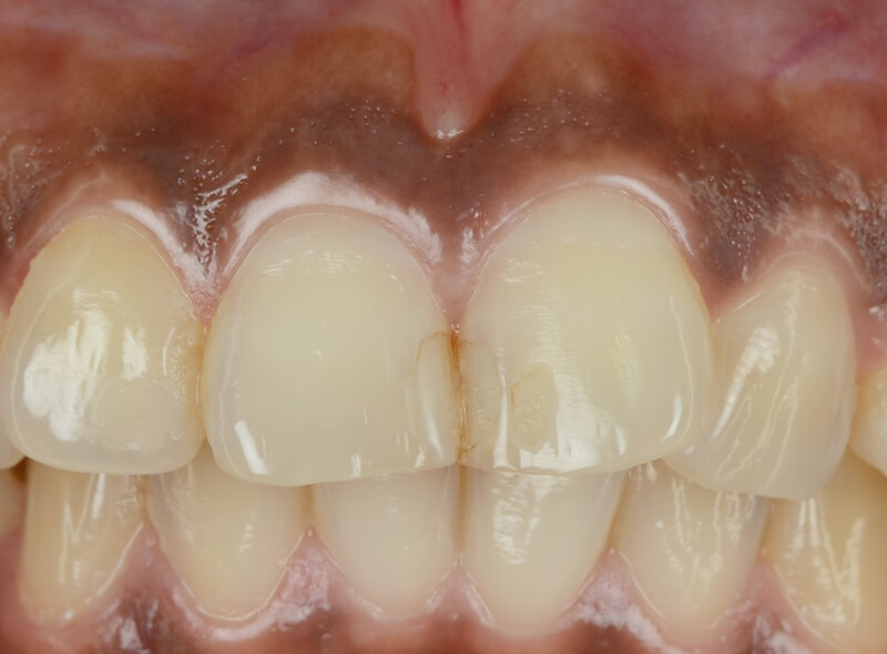 歯茎のホワイトニング治療前