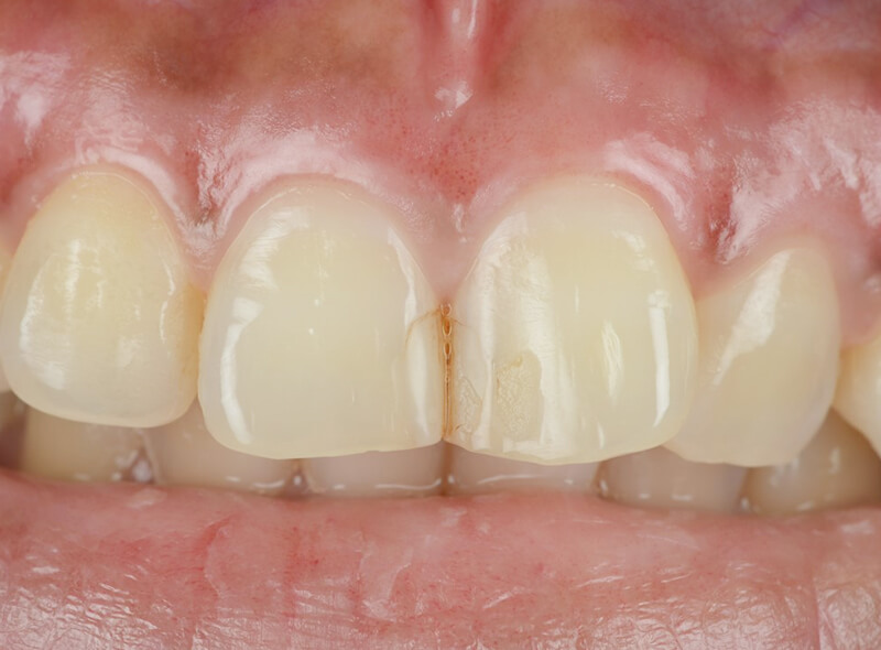 歯茎のホワイトニング治療後