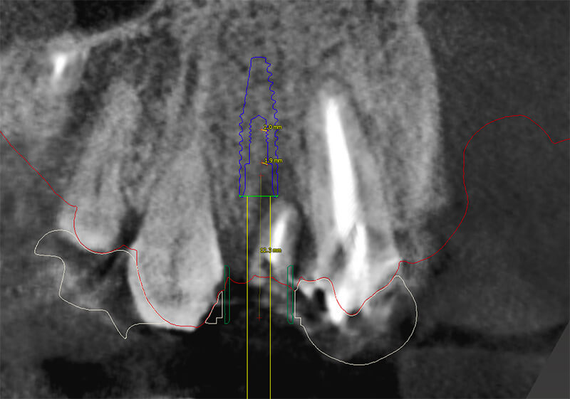 歯のCT画像２
