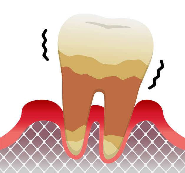 歯周病治療の風景