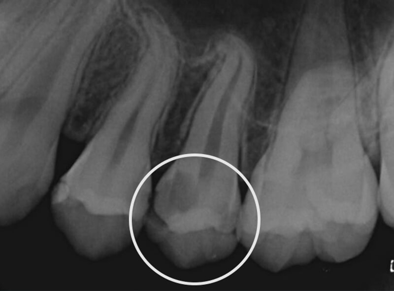 歯髄保存治療前のレントゲン写真