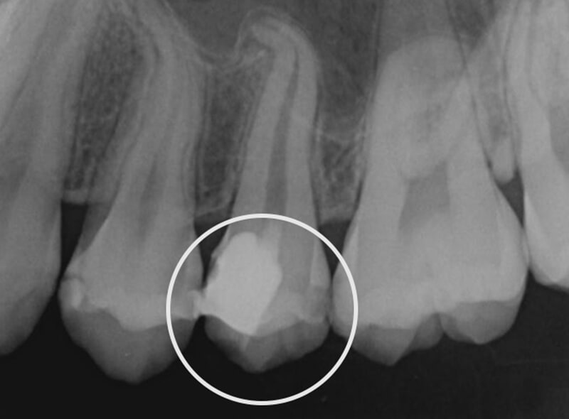 歯髄保存治療後のレントゲン写真