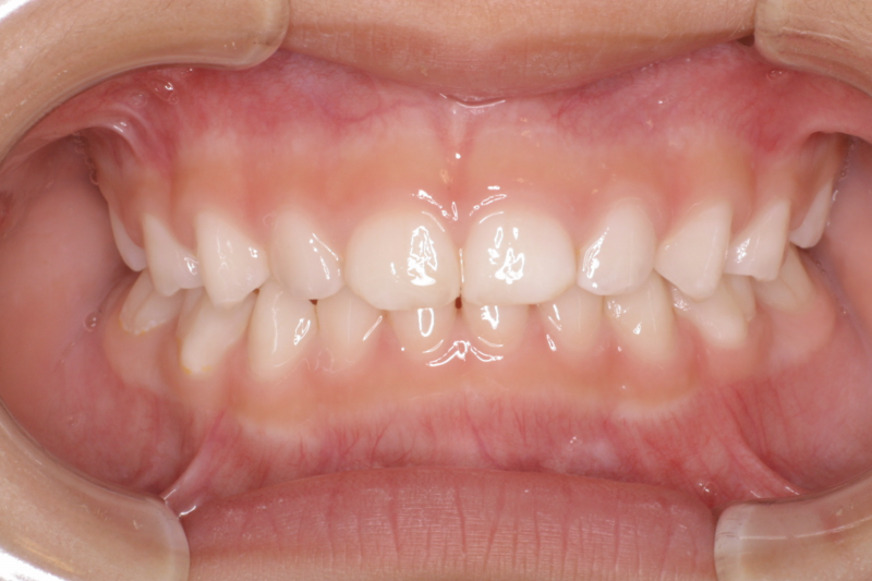 ３歳までに歯並びが決まってしまう 福岡市南区の歯医者 ひろたまさき歯科