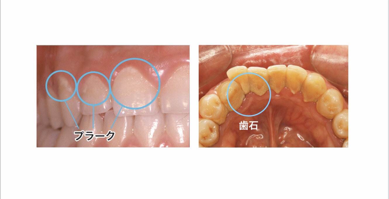 歯垢（プラーク）と歯石の違いはご存知ですか？ スタッフブログvol.64 | 福岡市南区の歯医者「ひろたまさき歯科・矯正歯科」