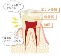 知覚過敏と虫歯の違いとは スタッフブログvol 106 福岡市南区の歯医者 ひろたまさき歯科