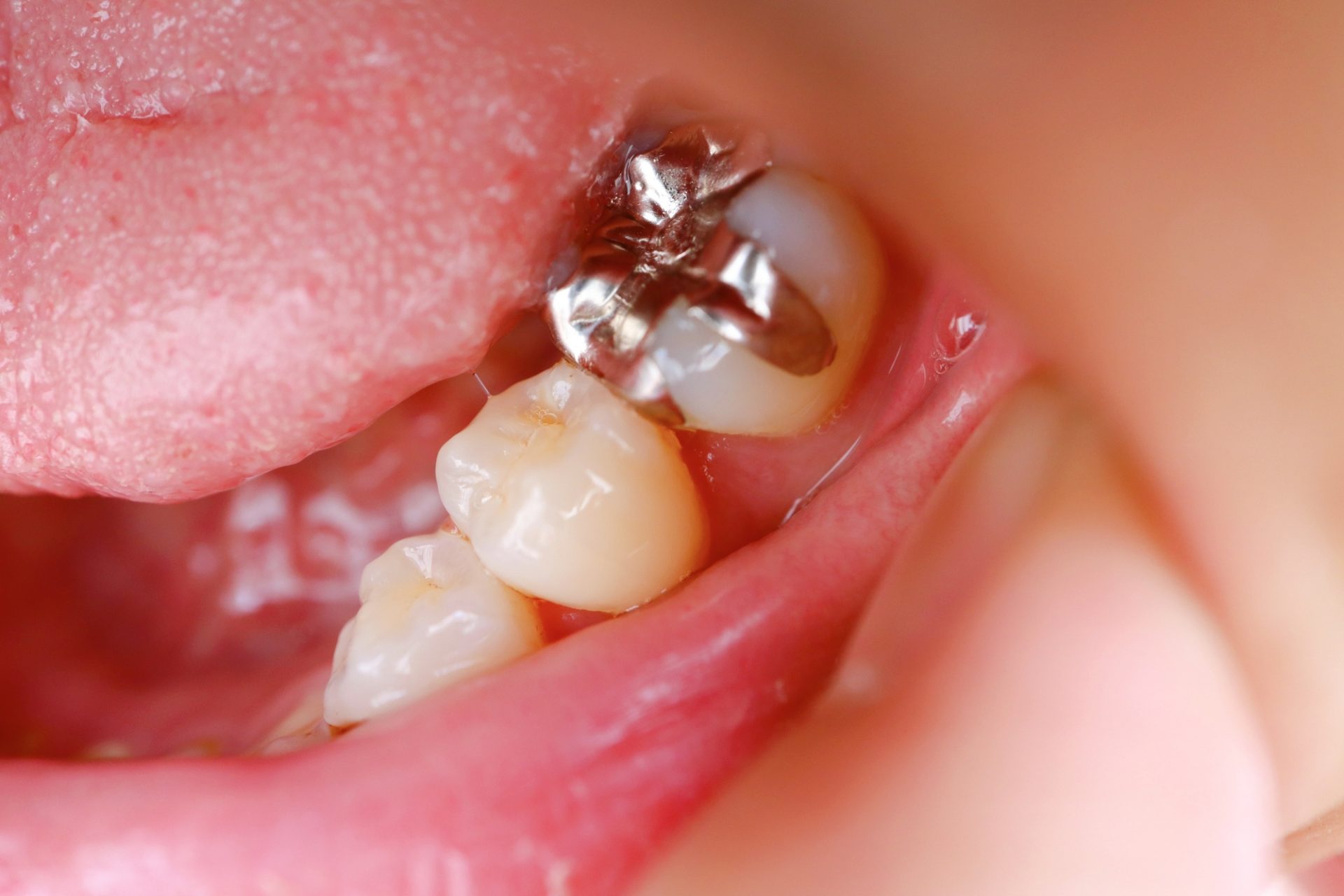 銀 歯 にし たく ない 奥歯